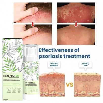 MS Ecze+ Anti Fungal Spray - Doctor's Recommended 👨🏽⚕️ Buy 1 Get 1 Free