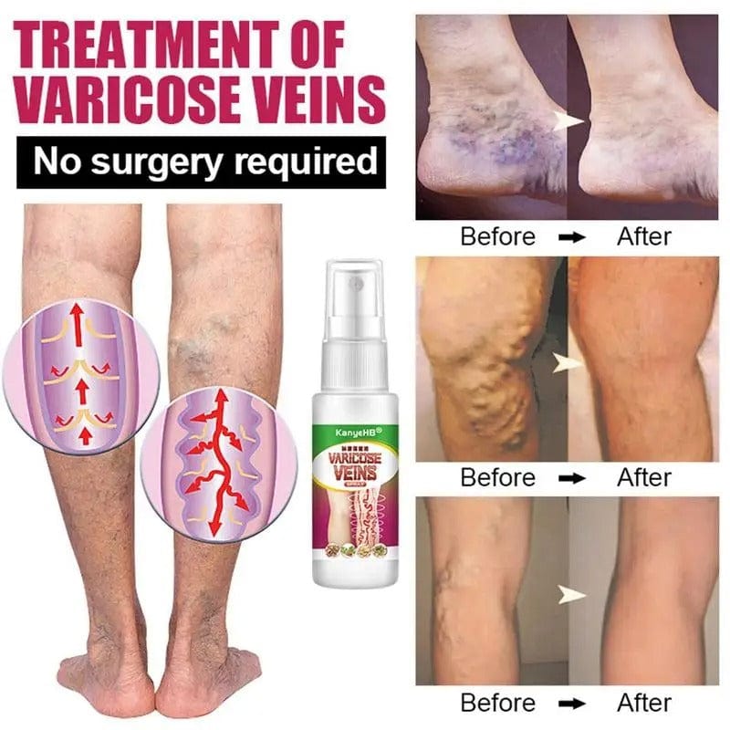 MS Herbal Varicose Vein Spray -  Vein Care Solution! 👨🏻⚕️ 💚 Buy 1 Get 1 Free 🔥
