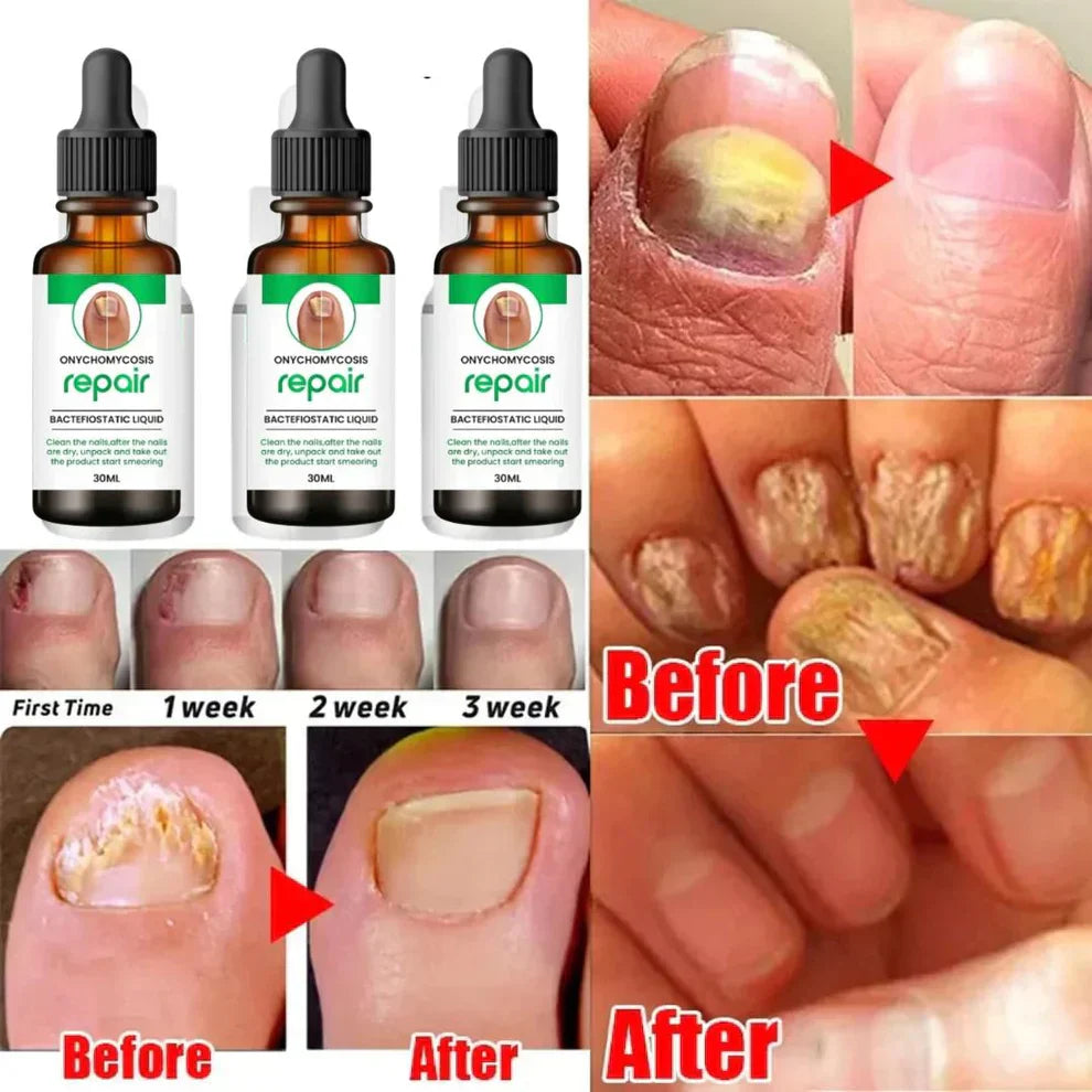 Nail Repair Serum (Buy 1 Get 1 Free)