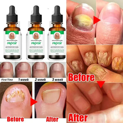 Nail Repair Serum (Buy 1 Get 1 Free)